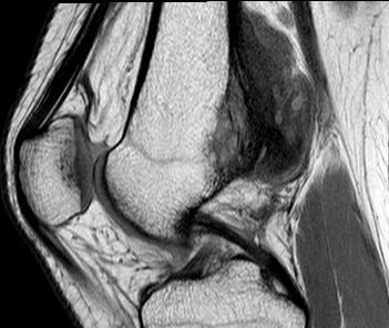 Parosteal Osteosarcoma MRI0002